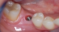 Rj implante dentrio