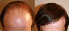 Foto 24 implantes de cabelos - Viana Cabelos Naturais