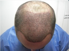 Foto 12 implantes de cabelos no Rio de Janeiro - Viana Cabelos Naturais
