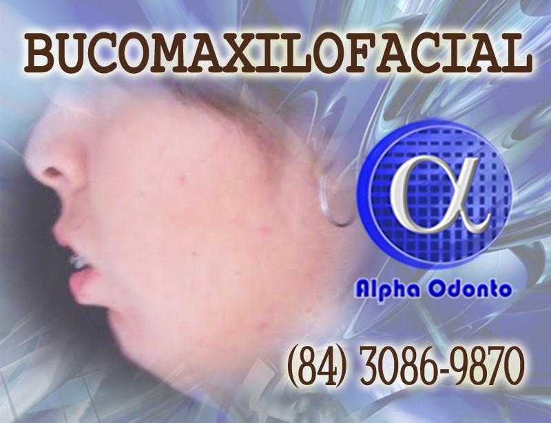 BUCOMAXILOFACIAL PACIENTE CLASSE 2  -  (84) 3086-9870