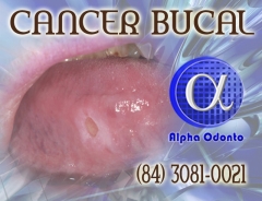 Percia clnica com bipsia para deteco de cncer bucal - (84) 3086-9870