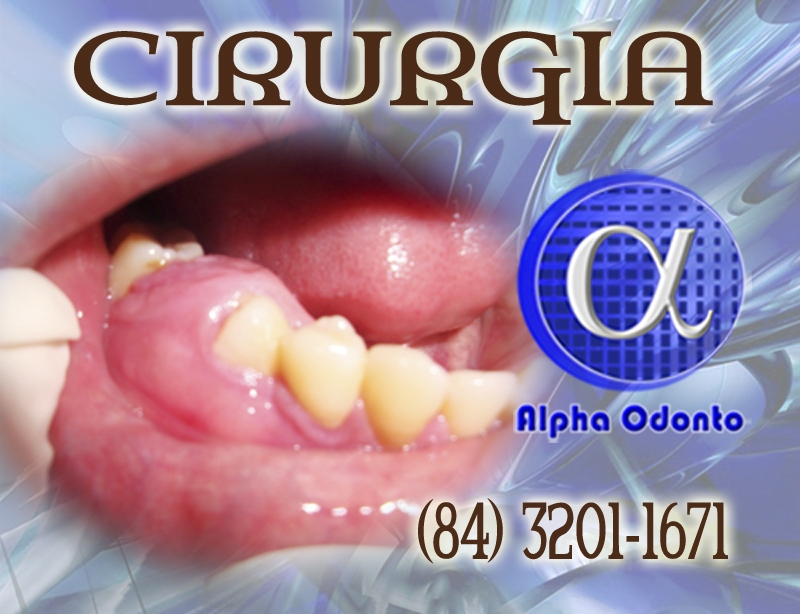 CIRURGIA DE ABSCESSO GENGIVAL - (84) 3086-9870