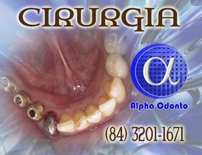 CIRURGIA DE IMPLANTE DENTÁRIO - (84) 3086-9870