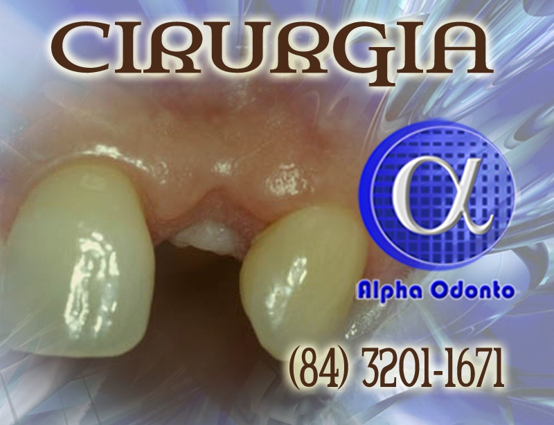 EXODONTIA SIMPLES - (84) 3086-9870