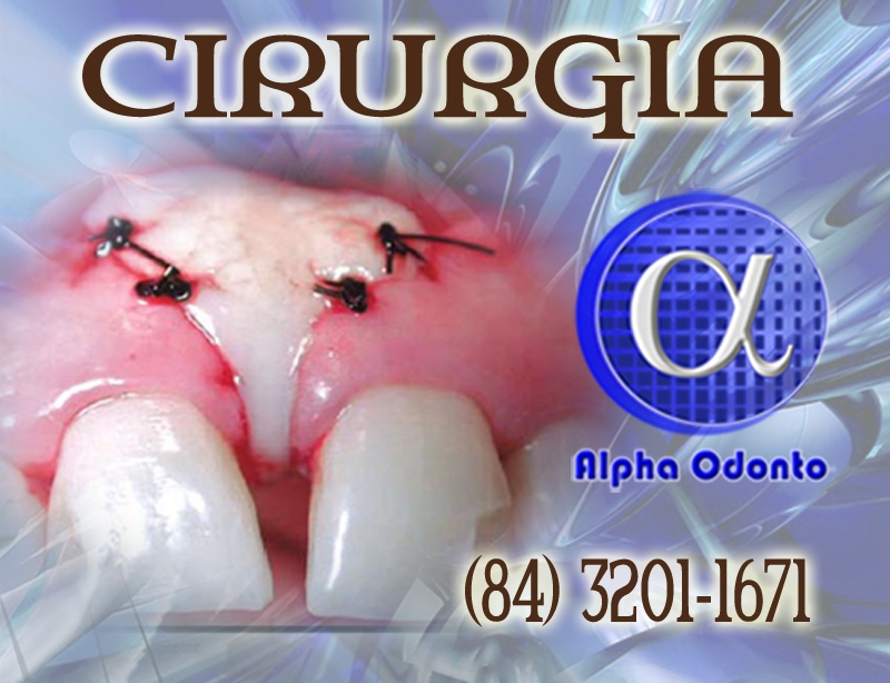 CIRURGIA DE ENXERTO ÓSSEO E GENGIVAL - (84) 3086-9870