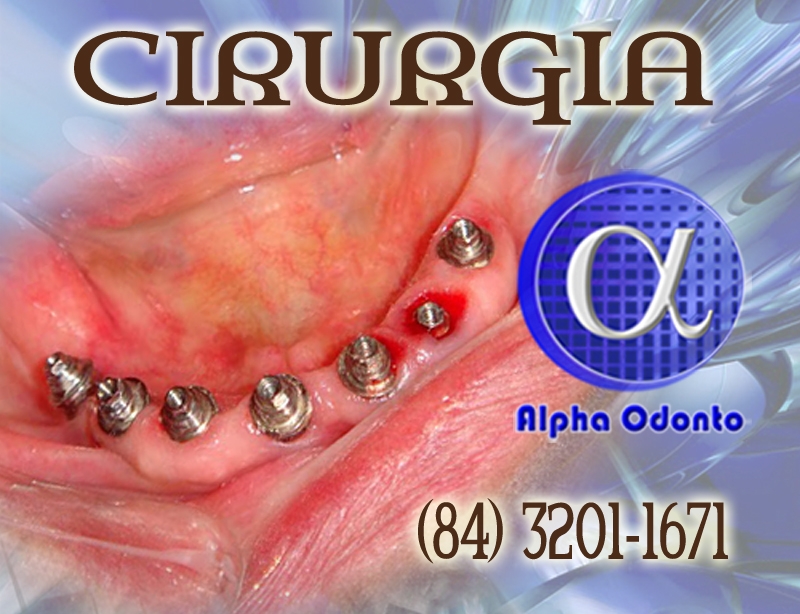 CIRURGIA DE IMPLANTE DENTRIO - (84) 3086-9870