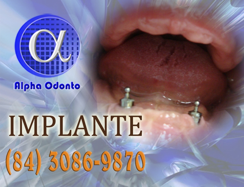 IMPLANTE DENTÁRIO TOTAL - (84) 3086-9870