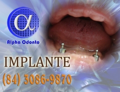 Implante dentrio total - (84) 3086-9870