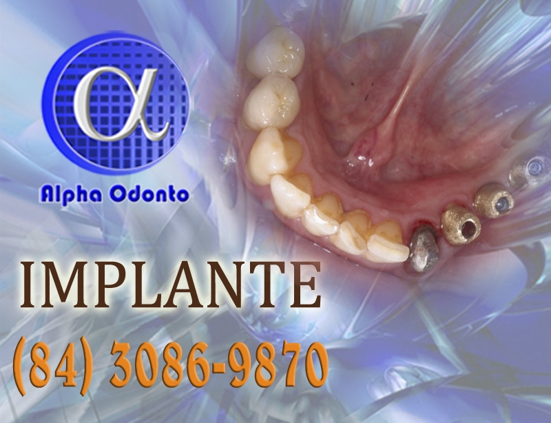 IMPLANTE DENTÁRIO INFERIOR PARCIAL - (84) 3086-9870