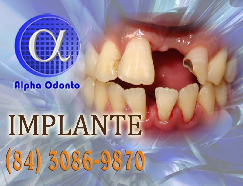 IMPLANTE DENTÁRIO INDIVIDUAL - (84) 3086-9870