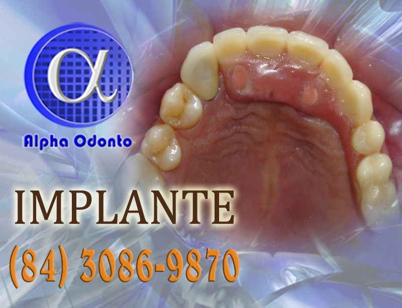 IMPLANTE DENTÁRIO PARCIAL SUPERIOR - (84) 3086-9870