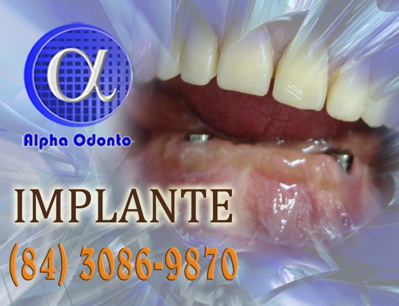 IMPLANTE DENTÁRIO TOTAL INFERIOR - (84) 3086-9870