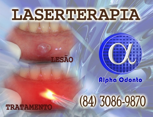 LASERTERAPIA PARA LESES LABIAIS - (84) 3086-9870