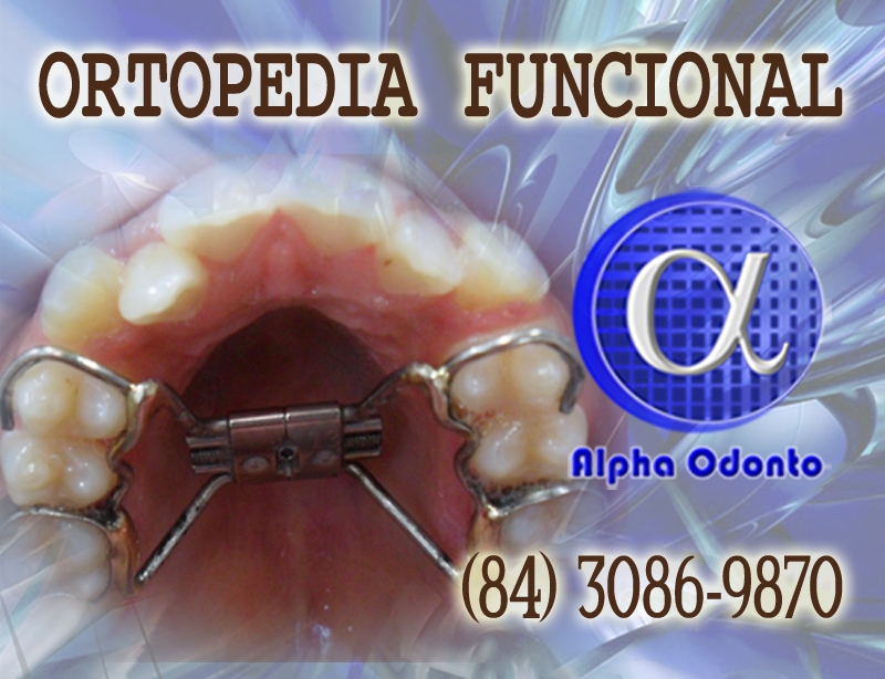 ORTOPEDIA FACIAL - (84) 3086-9870 - APARELHO ORTOPÉDICO