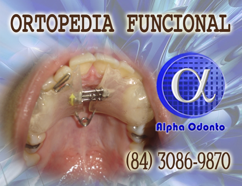 ORTOPEDIA FACIAL - (84) 3086-9870 - APARELHO ORTOPDICO