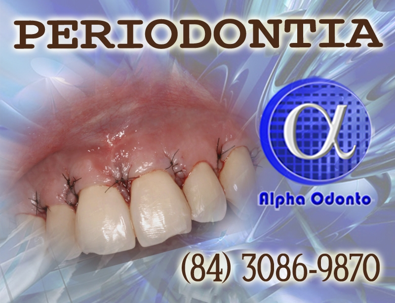 PERIODONTIA - ENXERTO GENGIVAL - (84) 3086-9870