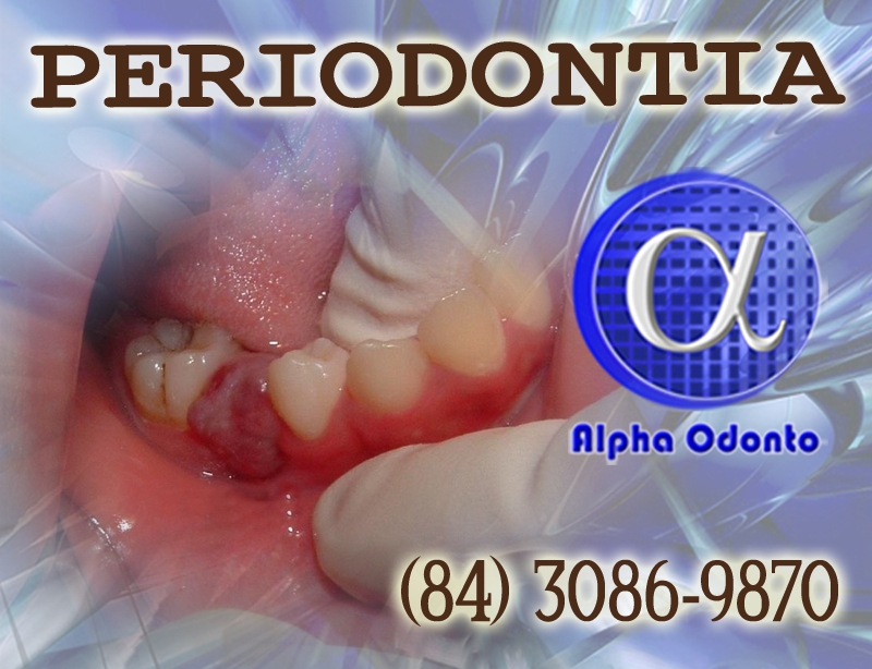 PERIODONTIA - GRANULOMA GENGIVAL TRATAMENTO DEFINITIVO - (84) 3086-9870