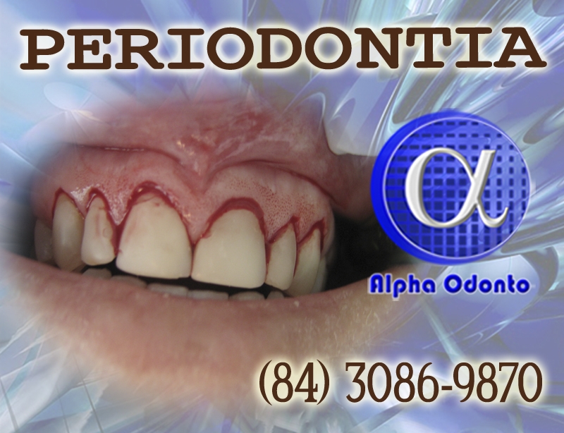 PERIODONTIA - GENGIVITE AVANADA TRATAMENTO DEFINITIVO - (84) 3086-9870