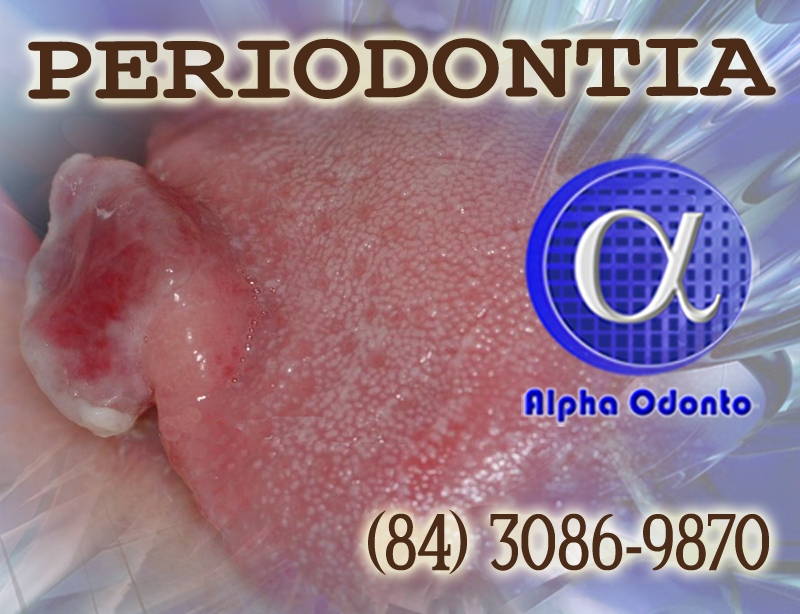 PERIODONTIA - GRANULOMA LINGUAL TRATAMENTO DEFINITIVO - (84) 3086-9870