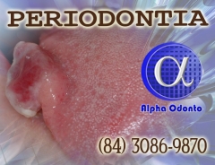 Periodontia - granuloma lingual tratamento definitivo - (84) 3086-9870