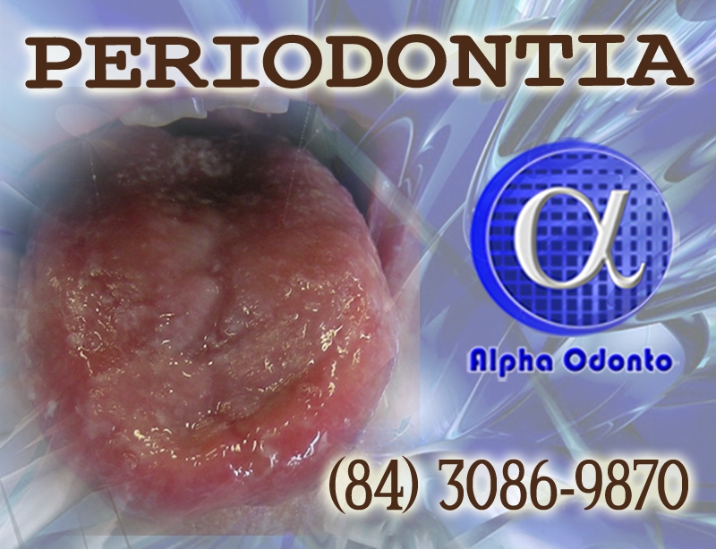 PERIODONTIA - MUCOSITE LINGUAL TRATAMENTO AVANÇADO - (84) 3086-9870