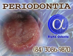 Periodontia - mucosite lingual tratamento avanado - (84) 3086-9870