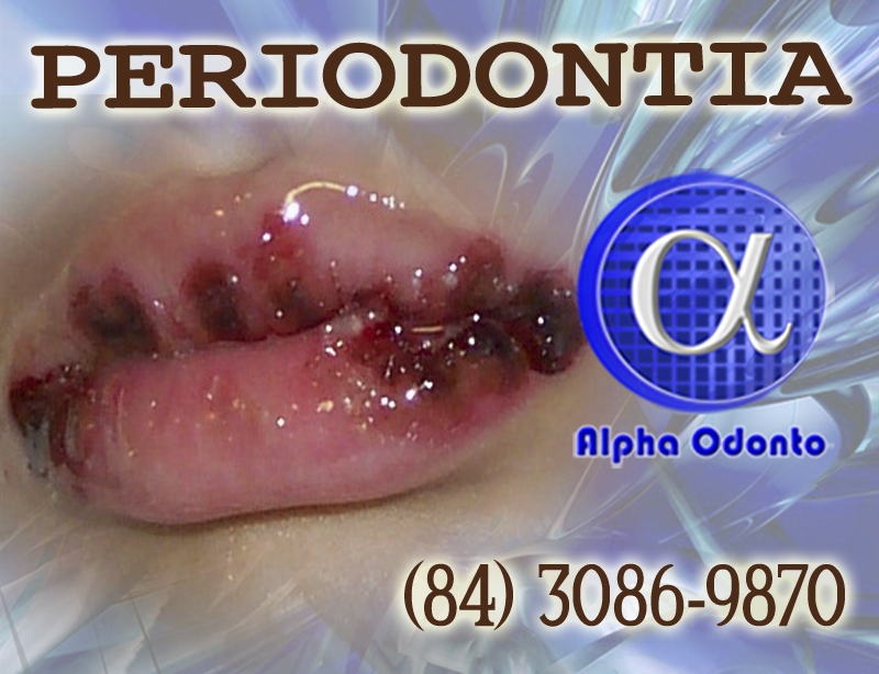 PERIODONTIA - MUCOSITE LABIAL TRATAMENTO EXTENSIVO - (84) 3086-9870