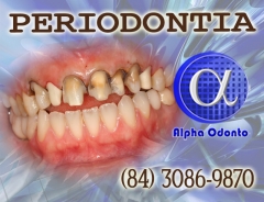 Periodontia - tratamento periodontal em geral - (84) 3086-9870