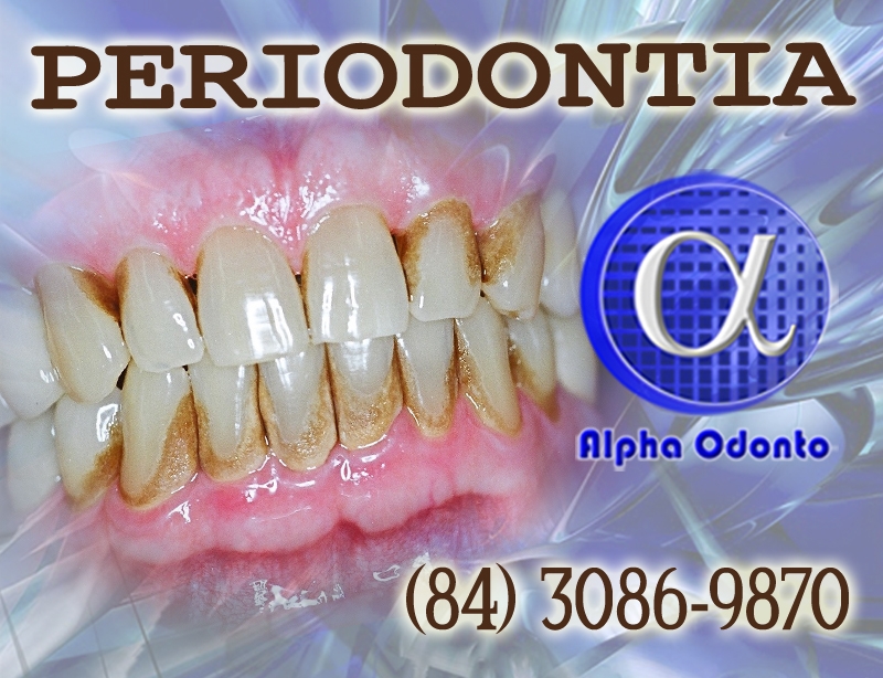 PERIODONTIA - TÁRTARO E PLACA BACTERIANA  TRATAMENTO DEFINITIVO - (84) 3086-9870