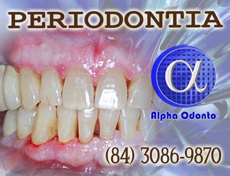 PERIODONTIA - PERIODONTITE TRATAMENTO EXCLUSIVO (84) 3086-9870