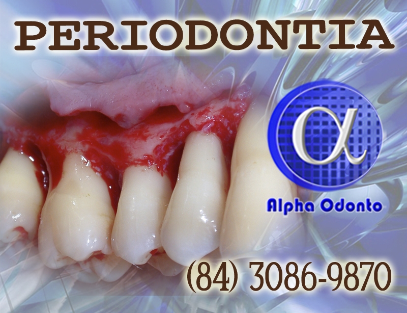 PERIODONTIA - TRATAMENTOS EXCLUSIVOS - (840 3086-9879