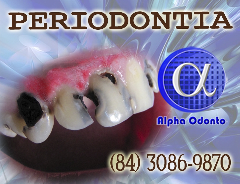 PERIODONTIA - TRATAMENTOS EXCLUSIVOS - (840 3086-9879