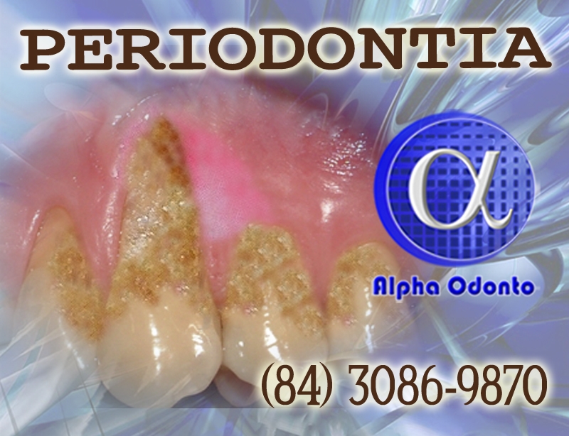 PERIODONTIA - TRATAMENTOS EXCLUSIVOS - (840 3086-9879