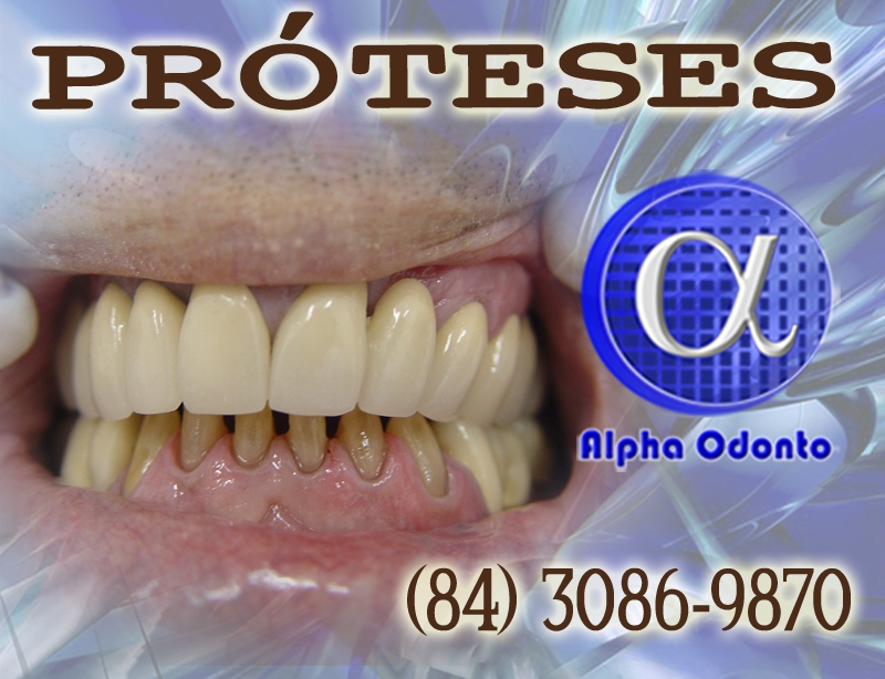 PRÓTESES DENTÁRIAS - TOTAIS E PARCIAIS ESTÉTICAS - (84) 3086-9870