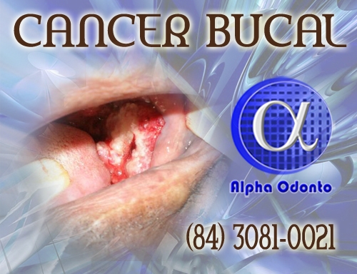 CNCER BUCAL DIAGNOSTICADO APS PERCIA E BIPSIA - (84) 3086-9870