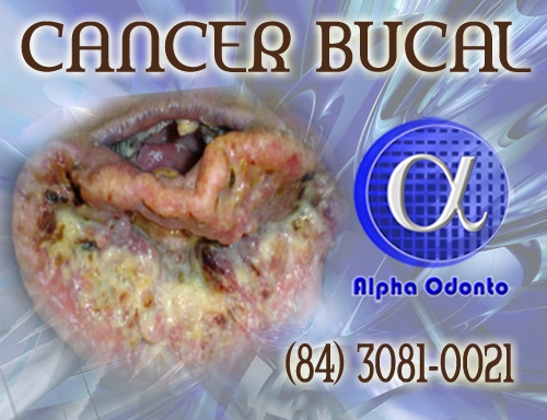 CÂNCER BUCAL AVANÇADO - (84) 3086-9870