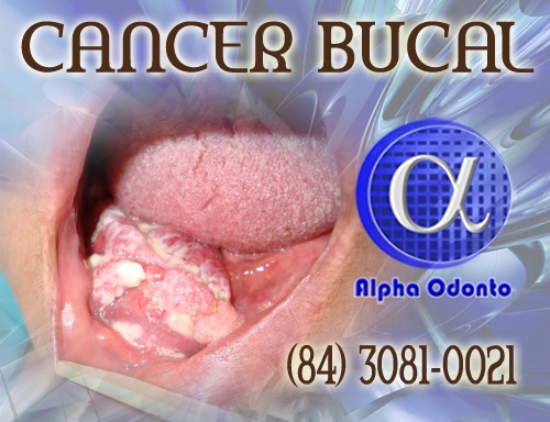 CÂNCER BUCAL DIAGNOSTICADO APÓS PERÍCIA E BIÓPSIA - (84) 3086-9870