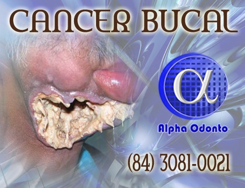 CÂNCER BUCAL AVANÇADO - (84) 3086-9870