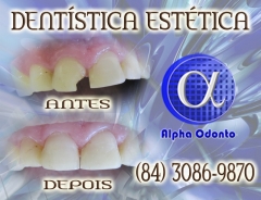 Dentstica esttica, perfeio em restaurao dentria - (84) 3086-9870