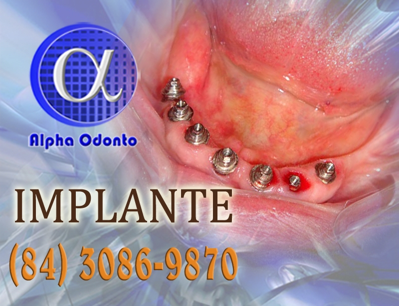 IMPLANTE DENTÁRIO ESTÉTICO - (84) 3086-9870