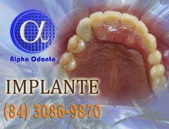 Implante dentrio esttico - (84) 3086-9870