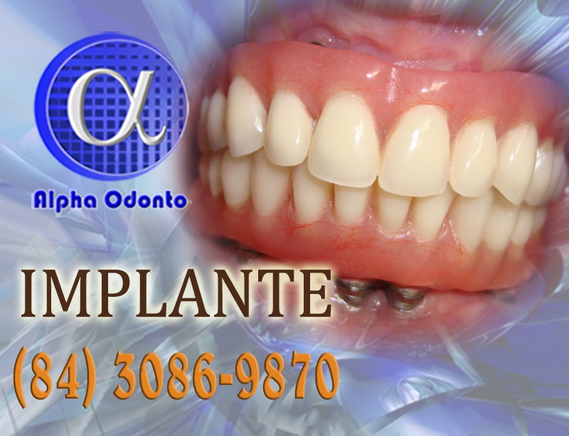 IMPLANTE DENTRIO ESTTICO - (84) 3086-9870