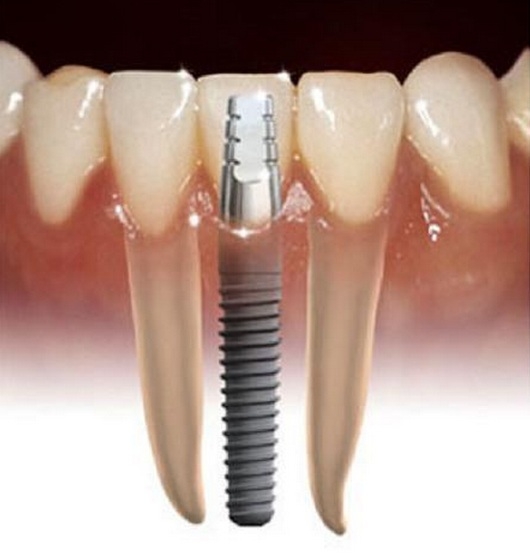Clínica Dentária Implante RJ