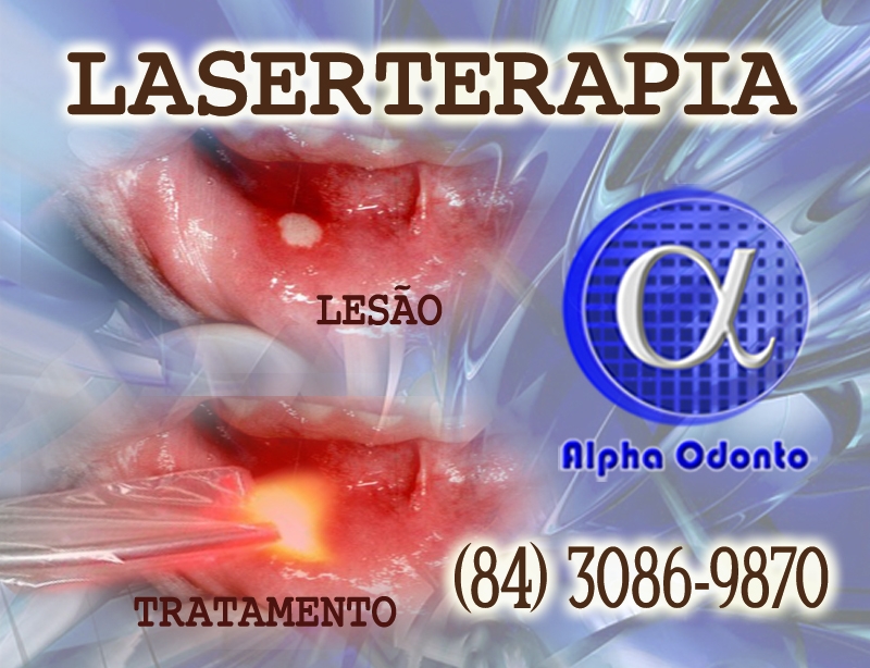 LASERTERAPIA ORAL EM NATAL - ALPHA ODONTO - (84) 3086-9870