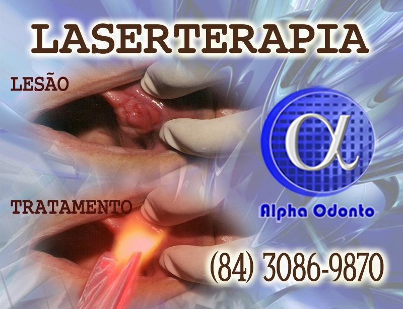 LASERTERAPIA ORAL EM NATAL - ALPHA ODONTO - (84) 3086-9870