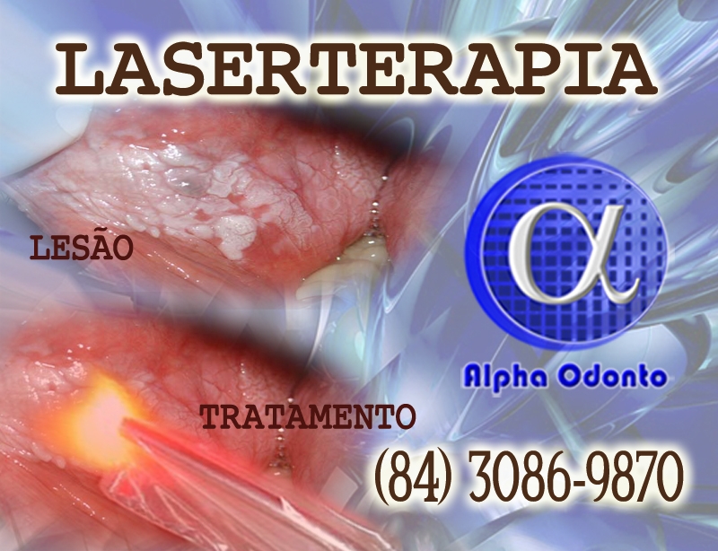 LASERTERAPIA ORAL EM NATAL - ALPHA ODONTO - (84) 3086-9870