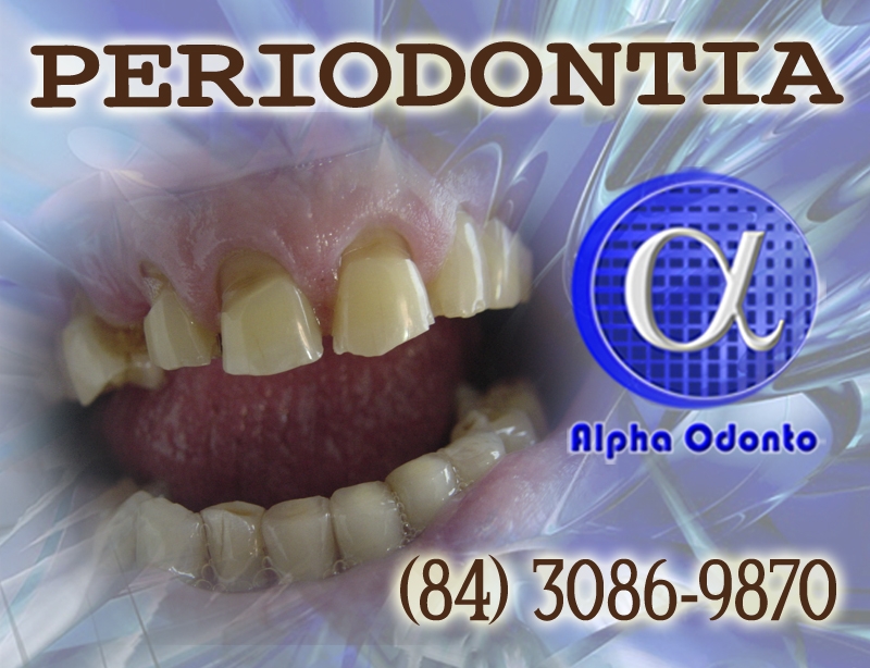 PERIODONTIA EM NATAL - ALPHA ODONTO - (84) 3086-9870