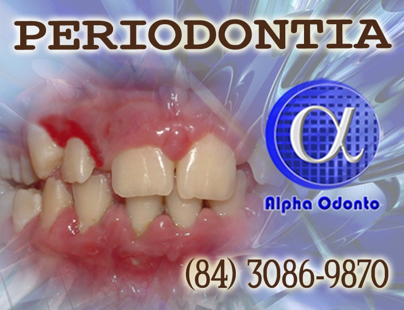 PERIODONTIA EM NATAL - ALPHA ODONTO - (84) 3086-9870