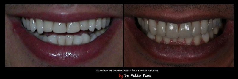 facetas de porcelana lente de contato