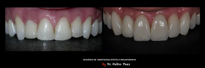 facetas de porcelana lente de contato